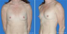 Breast Augmentation Before Photo by William Franckle, MD; Voorhees, NJ - Case 29015