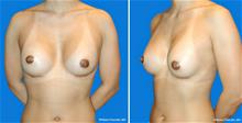 Breast Augmentation After Photo by William Franckle, MD; Voorhees, NJ - Case 29032