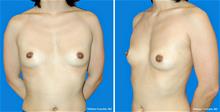 Breast Augmentation Before Photo by William Franckle, MD; Voorhees, NJ - Case 29032