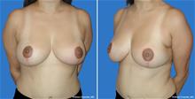 Breast Lift After Photo by William Franckle, MD; Voorhees, NJ - Case 29033