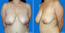 Breast Lift Before Photo by William Franckle, MD; Voorhees, NJ - Case 29033