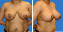 Breast Reduction After Photo by William Franckle, MD; Voorhees, NJ - Case 29284