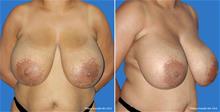 Breast Reduction Before Photo by William Franckle, MD; Voorhees, NJ - Case 29284