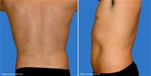 Liposuction After Photo by William Franckle, MD; Voorhees, NJ - Case 29375