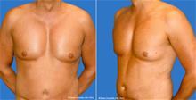 Male Breast Reduction After Photo by William Franckle, MD; Voorhees, NJ - Case 29426