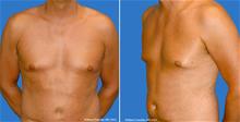 Male Breast Reduction Before Photo by William Franckle, MD; Voorhees, NJ - Case 29426