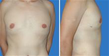 Male Breast Reduction After Photo by William Franckle, MD; Voorhees, NJ - Case 29427
