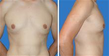 Male Breast Reduction Before Photo by William Franckle, MD; Voorhees, NJ - Case 29427