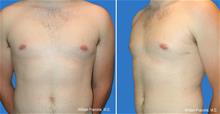 Male Breast Reduction After Photo by William Franckle, MD; Voorhees, NJ - Case 29428
