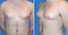 Male Breast Reduction Before Photo by William Franckle, MD; Voorhees, NJ - Case 29428