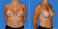 Breast Augmentation After Photo by William Franckle, MD; Voorhees, NJ - Case 29462