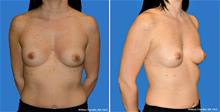 Breast Augmentation Before Photo by William Franckle, MD; Voorhees, NJ - Case 29462