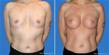 Breast Augmentation Before Photo by William Franckle, MD; Voorhees, NJ - Case 29463