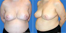 Breast Reduction After Photo by William Franckle, MD; Voorhees, NJ - Case 29558