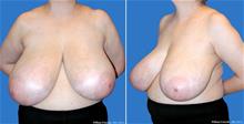 Breast Reduction Before Photo by William Franckle, MD; Voorhees, NJ - Case 29558