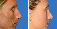 Rhinoplasty After Photo by William Franckle, MD; Voorhees, NJ - Case 29807